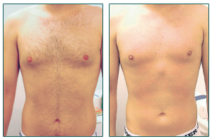 Laser Hair Removal Before And After Photo 1