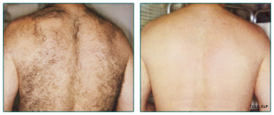 Laser Hair Removal Before And After Photo 3