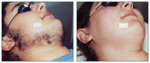 Laser Hair Removal Before And After Photo 5
