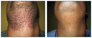 Laser Hair Removal Before And After Photo 4